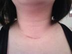 neckwithincision.jpg